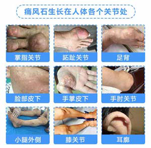 成都治疗痛风石